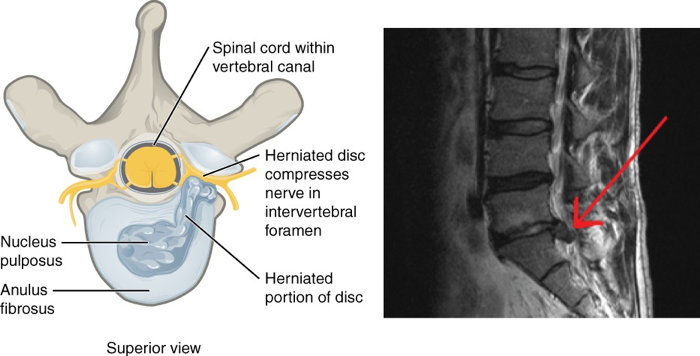 Vertebral disc bulging and Hernia – Picture 1